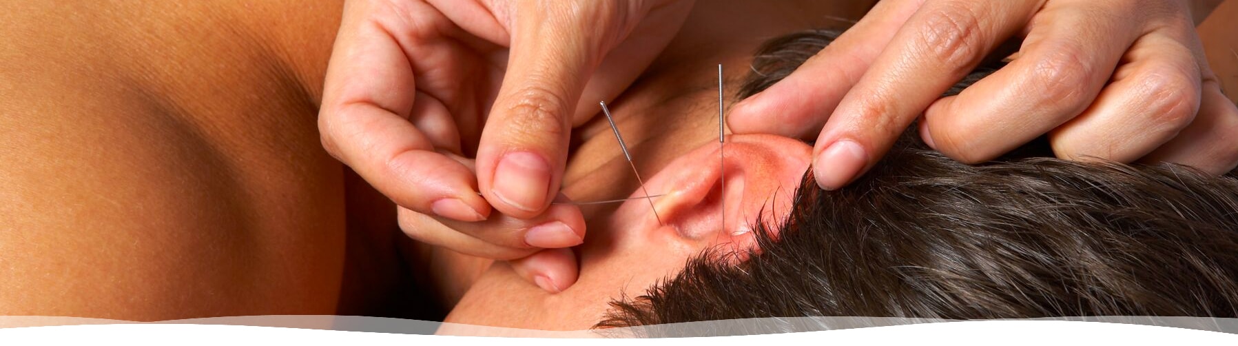 Acupuncture