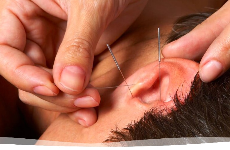 Acupuncture