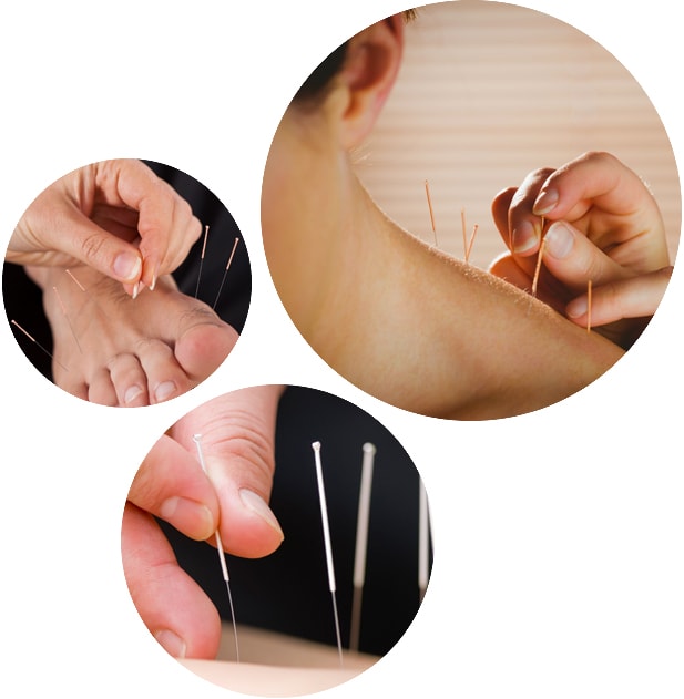 Acupuncture
